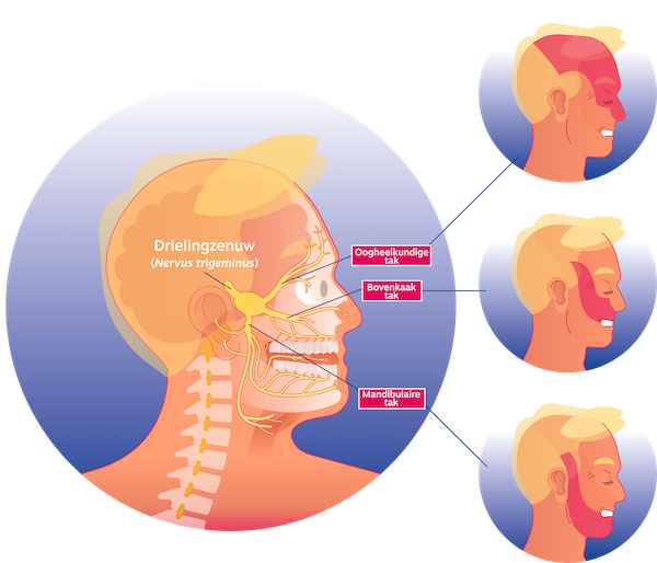 Illustratie van de zenuw in het gezicht die Trigeminus neuralgie, de meest bekende vorm van aangezichtspijn, veroorzaakt