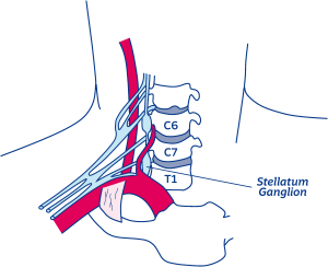 illustratie van de locatie van het ganglion stellatum, ook wel zenuwknoop genoemd, in de hals achter de C7 en T1 wervel.