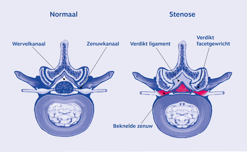 Illustratie van wervelkanaalstenose in de rug (lumbale wervelkanaalstenose)
